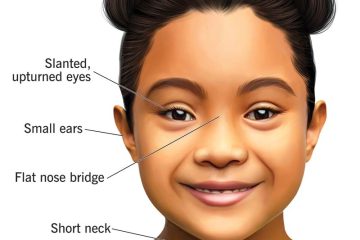 Symptoms & Causes of Down Syndrome
