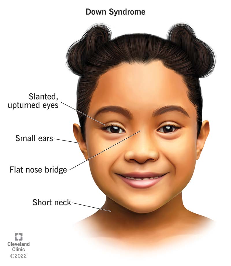 Symptoms & Causes of Down Syndrome