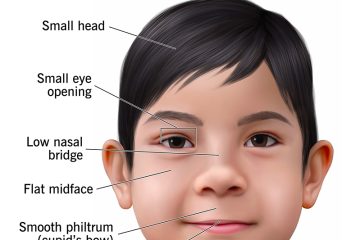 Fetal Alcohol Syndrome