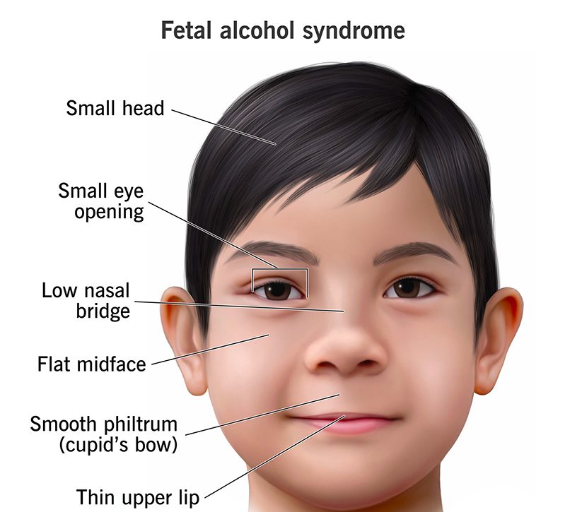 Fetal Alcohol Syndrome