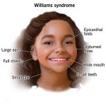 Williams Syndrome