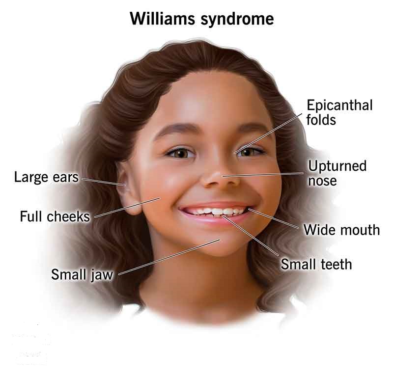 Williams Syndrome