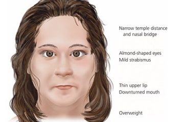 Prader Willi Syndrome