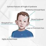 fragile-x syndrome
