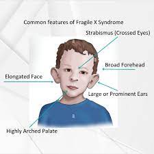 Fragile X Syndrome (FXS): What It Is, Symptoms, and Treatment - Brimex ...